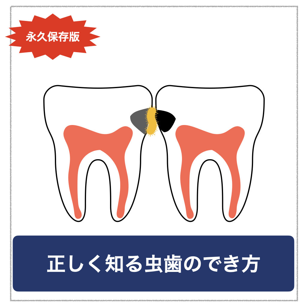 永久保存版 知っているようで知らない虫歯のでき方 イラスト解説 予防歯科情報ープライムデンタルネット